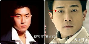 整容部位三:雙眼皮