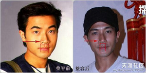 整容部位五,嘴唇 (縮唇,改變唇形)