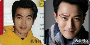 毛毛蟲眉毛通過激光脫毛手術變疏密恰當精致的劍眉整容部位:眉毛