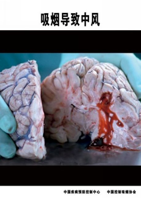 2013年世界無煙日