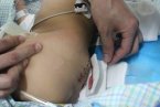 湖南尾巴男嬰手術很成功 不切除小尾巴可致癱瘓