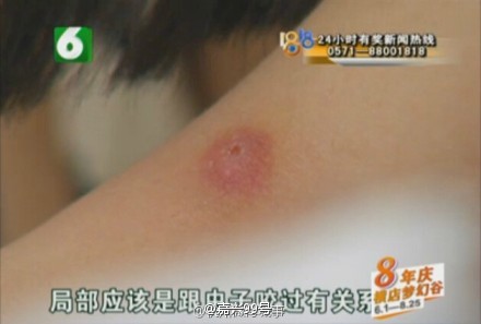 杭州姑娘手臂上寄生了皮膚蠅幼蟲