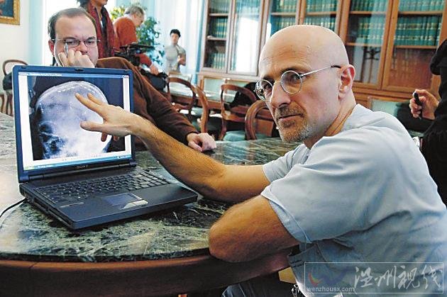 全球首例人頭移植手術圖片