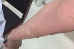 店員熱湯澆女顧客進展 火鍋店墊付2萬元醫療費嫌犯