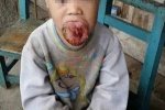 巨舌男童 4歲男童天生長巨大舌頭