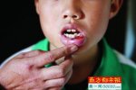小學男孩上課被老師打傷 中山新徽學校英語老師打學