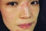 舒淇面部過敏紅腫自拍