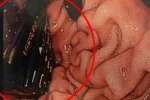 愛爾蘭男子手機吞入食道 什么都吃??？
