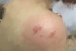 女子被蟲叮咬后休克 隱翅蟲咬人