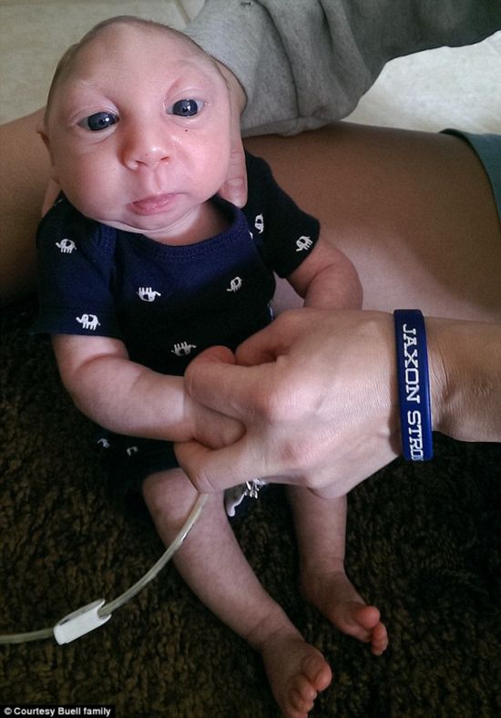 無腦畸形男嬰存活