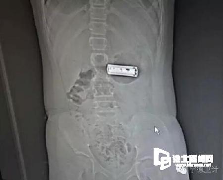 10歲女孩誤吞電池