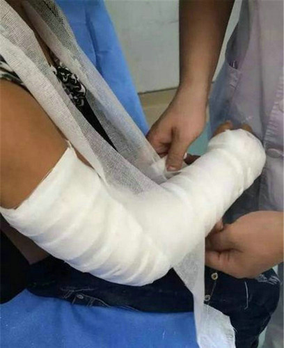 學(xué)生被老師推骨折