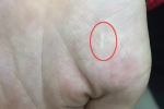 江湖游醫割手治眼 近視要佩戴眼鏡