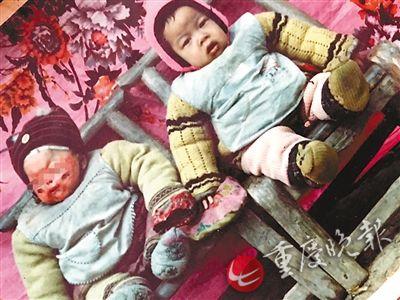 男童臉燒傷遭遺棄