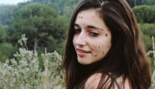 少女全身500處痣