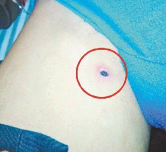 紹興男子被恙蟲咬后發高燒