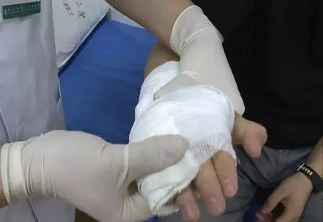 看世界杯把手拍斷骨折