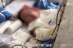 女子燒香掉香灰池導致燒傷