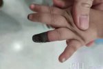 家人錯(cuò)誤包扎致3歲女童手指壞死 無(wú)知的奶奶