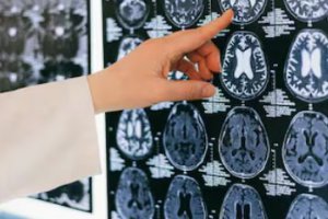 到2023年中國慢性腎病病例1.52億印度1.38億例